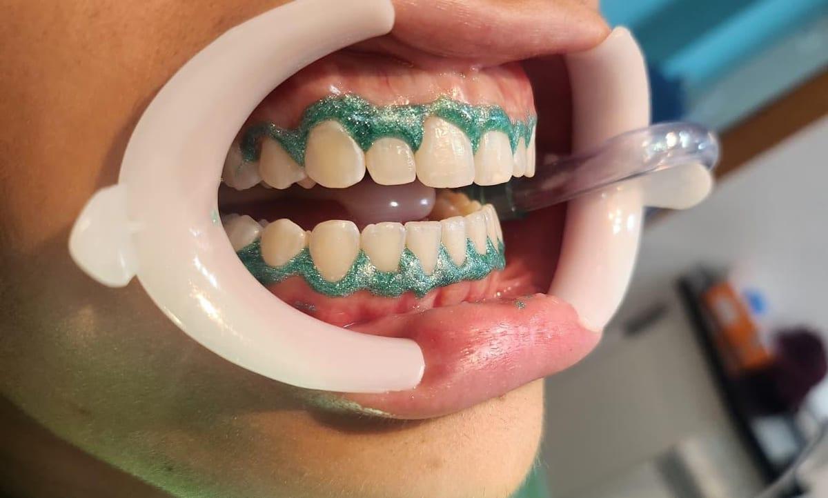 Arcada dentária com afastador labial e barreira gengival aplicada, durante sessão de clareamento em consultório
